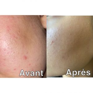 anti acné - anti imperfection