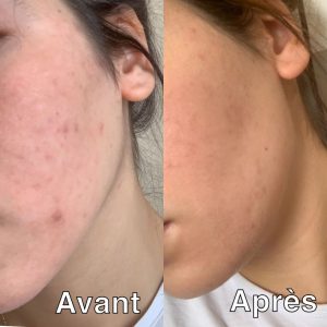 anti acné - anti imperfection