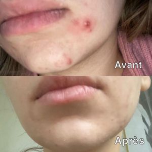 anti acné - anti imperfection